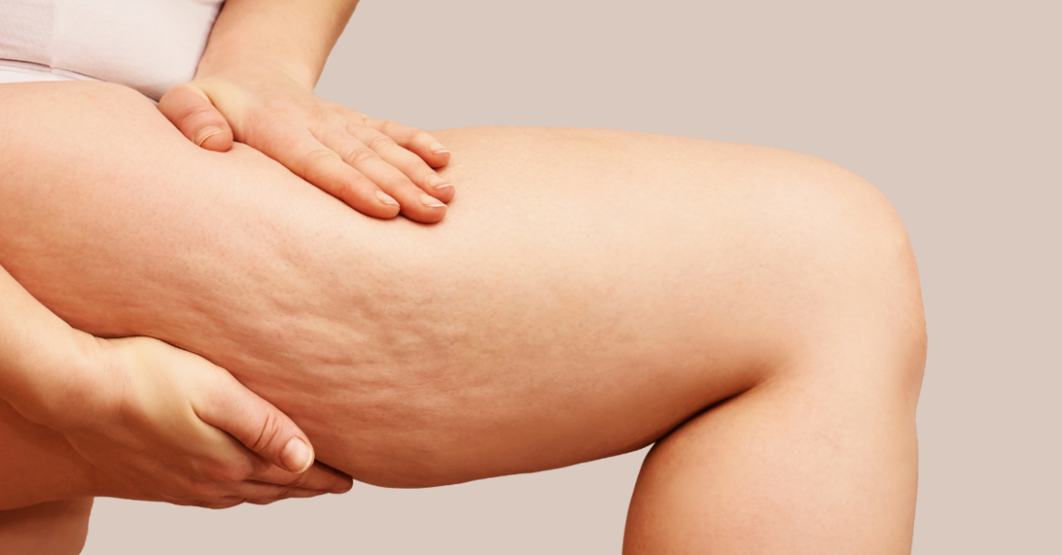 Selülit Nedir? Nasıl Geçer?